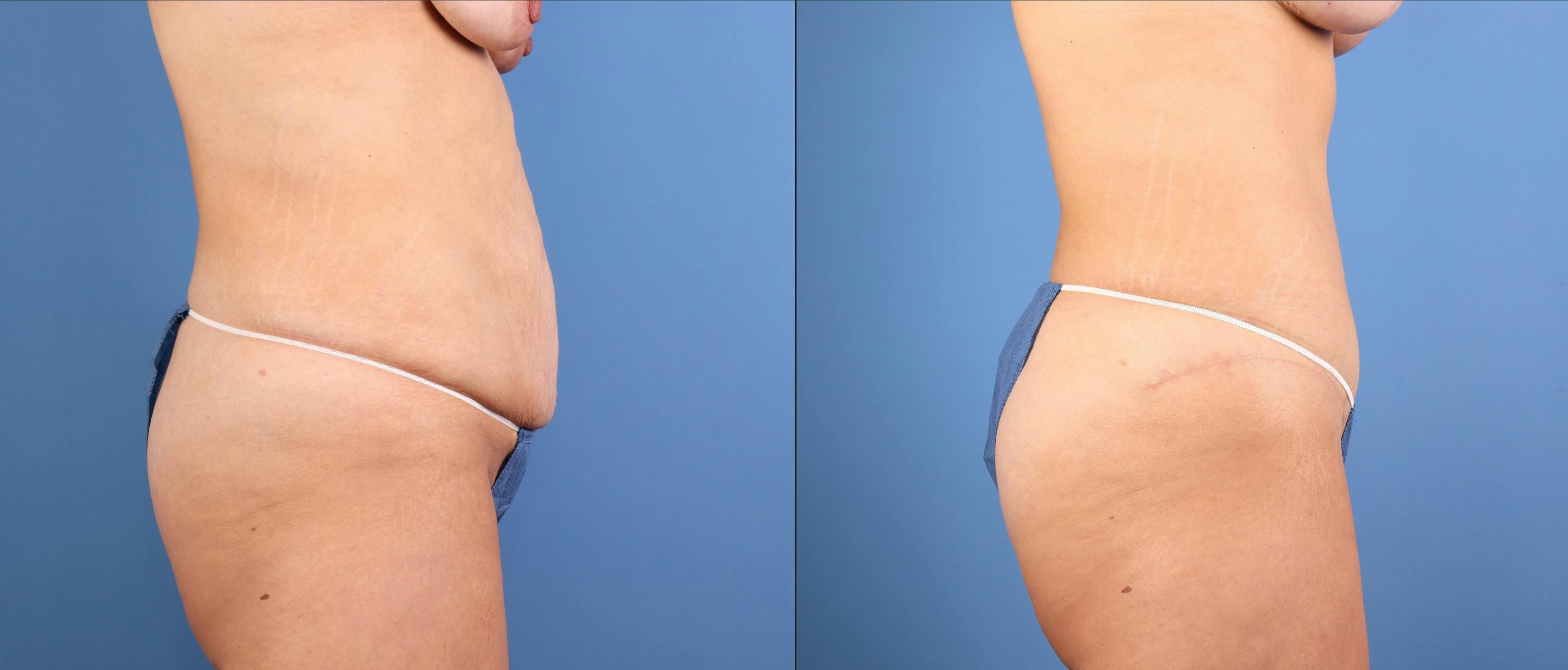 Mommy Makeover Before & After Gallery - Patient 427407 - Image 3