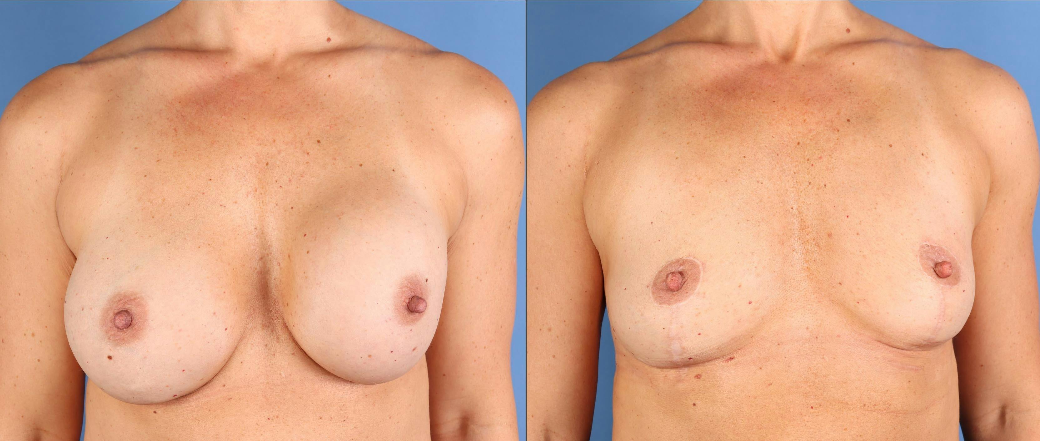 Breast Implant Removal Before & After Gallery - Patient 145795 - Image 1