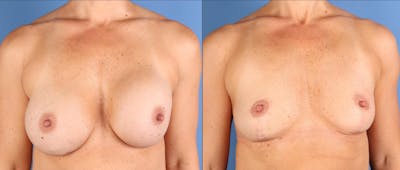 Breast Lift Before & After Gallery - Patient 361989 - Image 1