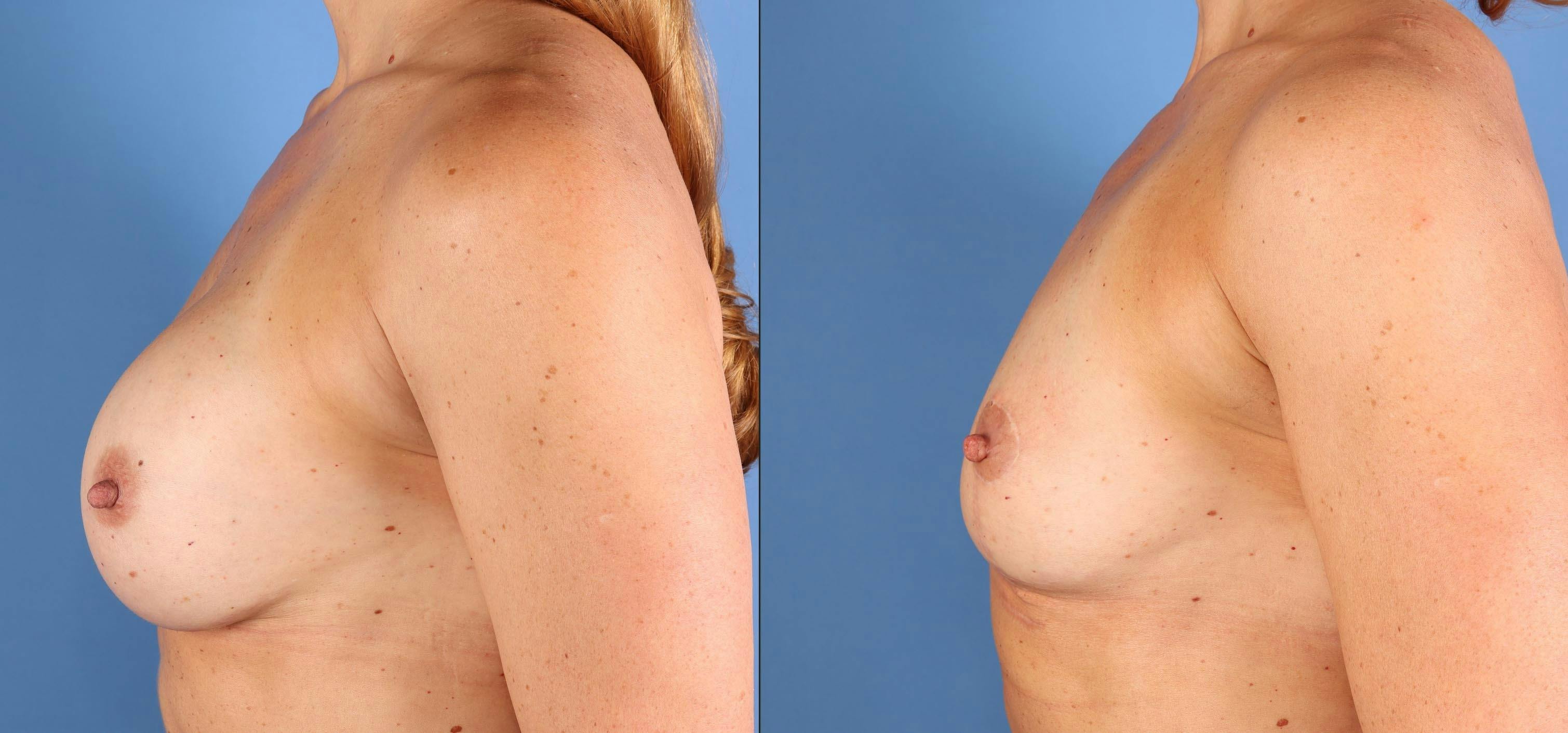 Breast Implant Removal Before & After Gallery - Patient 145795 - Image 3