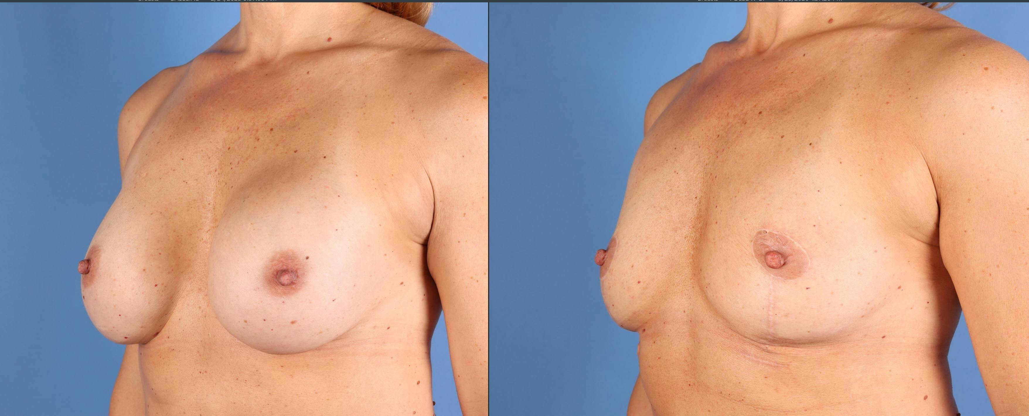 Breast Implant Removal Before & After Gallery - Patient 145795 - Image 2