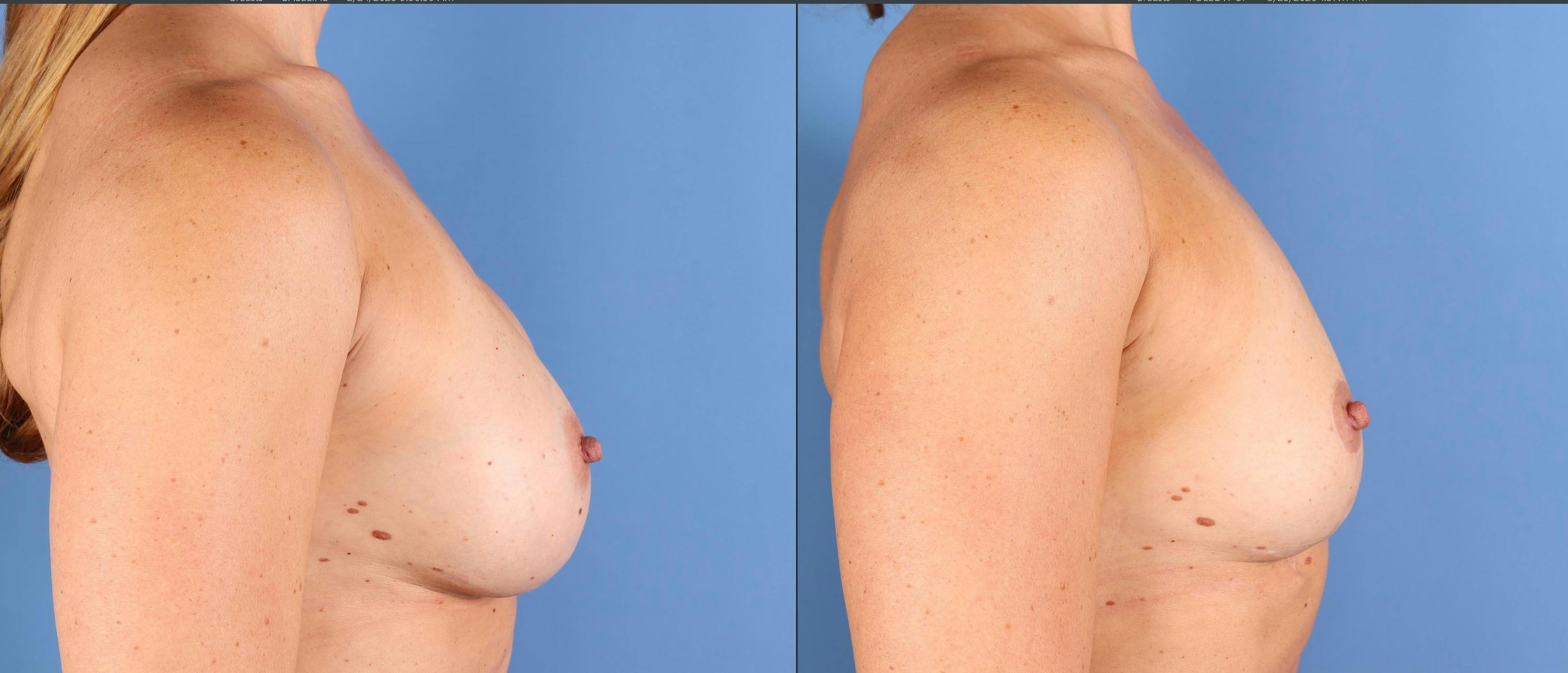 Breast Implant Removal Before & After Gallery - Patient 145795 - Image 5