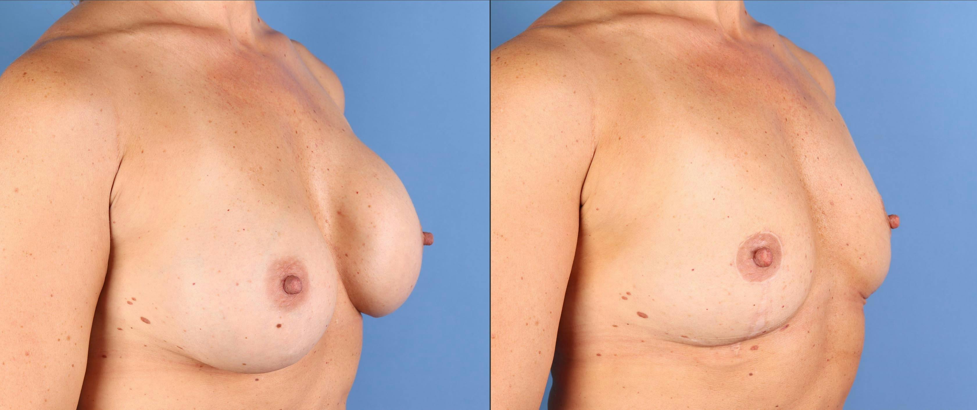 Breast Implant Removal Before & After Gallery - Patient 145795 - Image 4