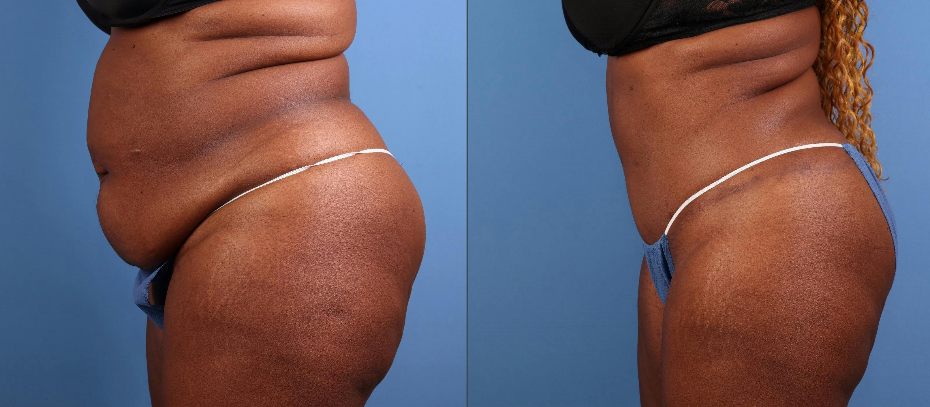 Abdomen Before & After Gallery - Patient 271002 - Image 6