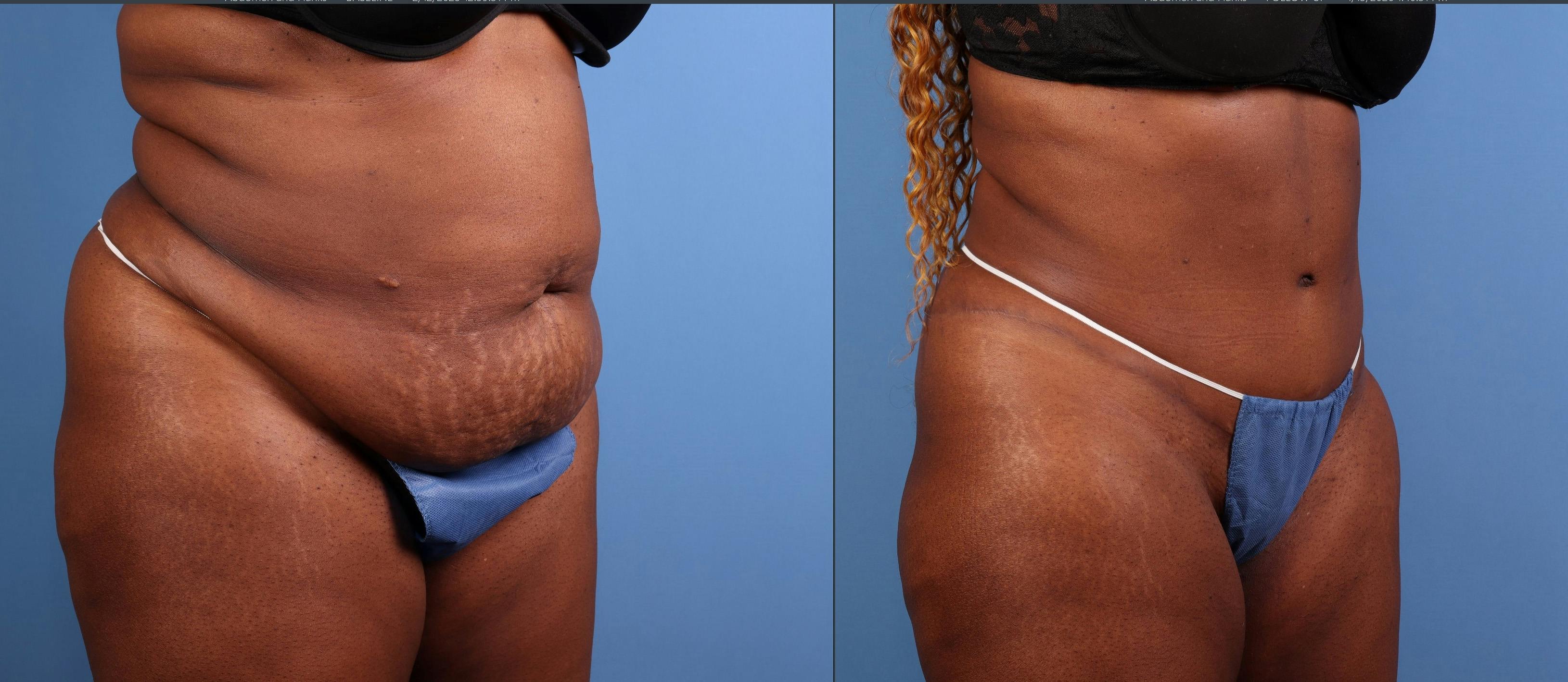 Abdomen Before & After Gallery - Patient 271002 - Image 2