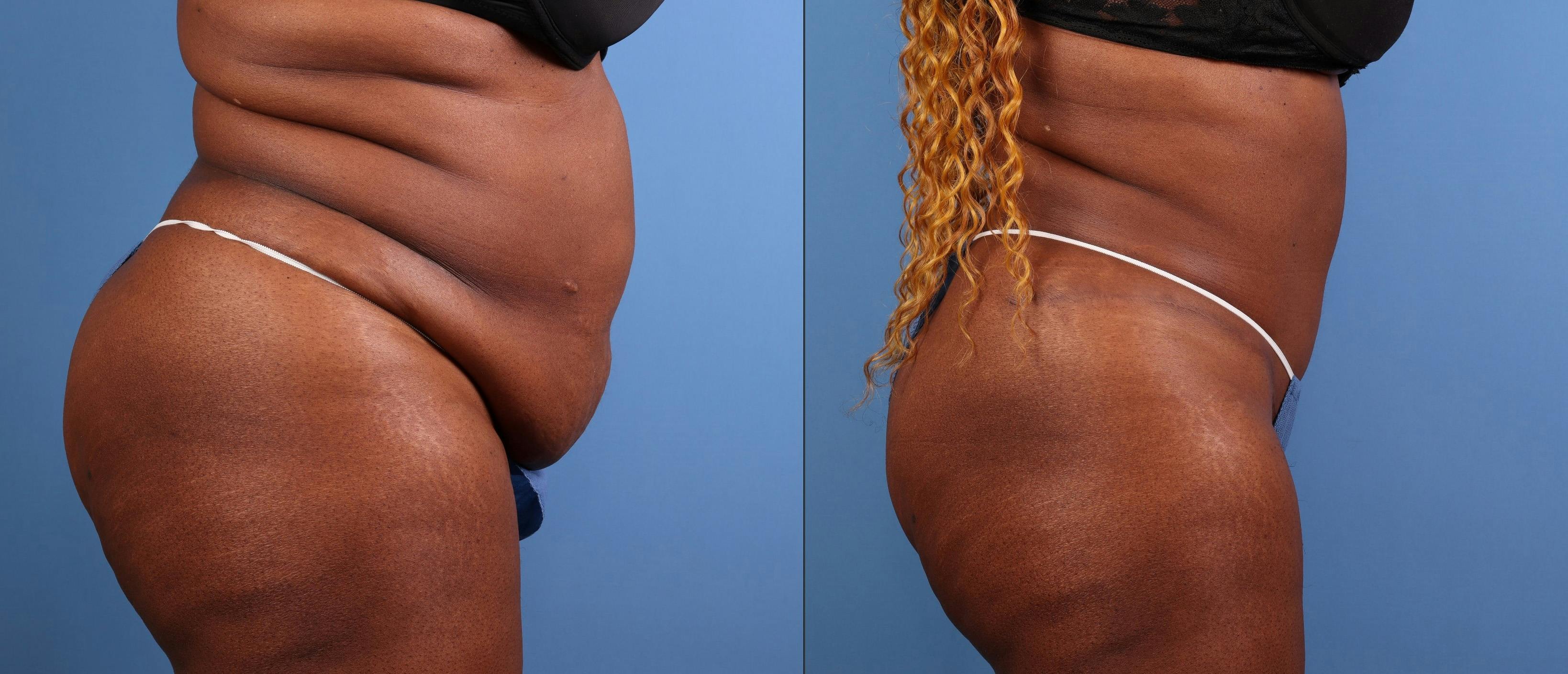 Abdomen Before & After Gallery - Patient 271002 - Image 3
