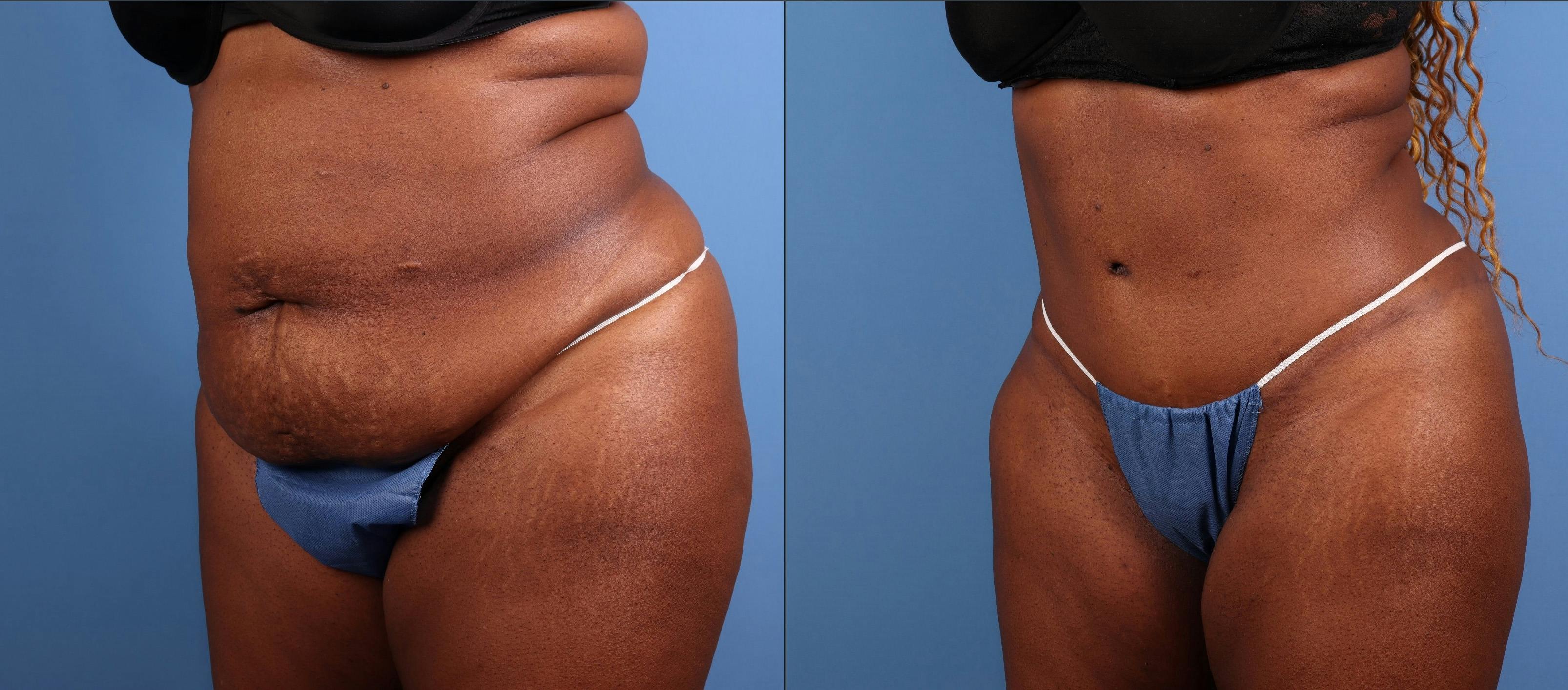 Abdomen Before & After Gallery - Patient 271002 - Image 5