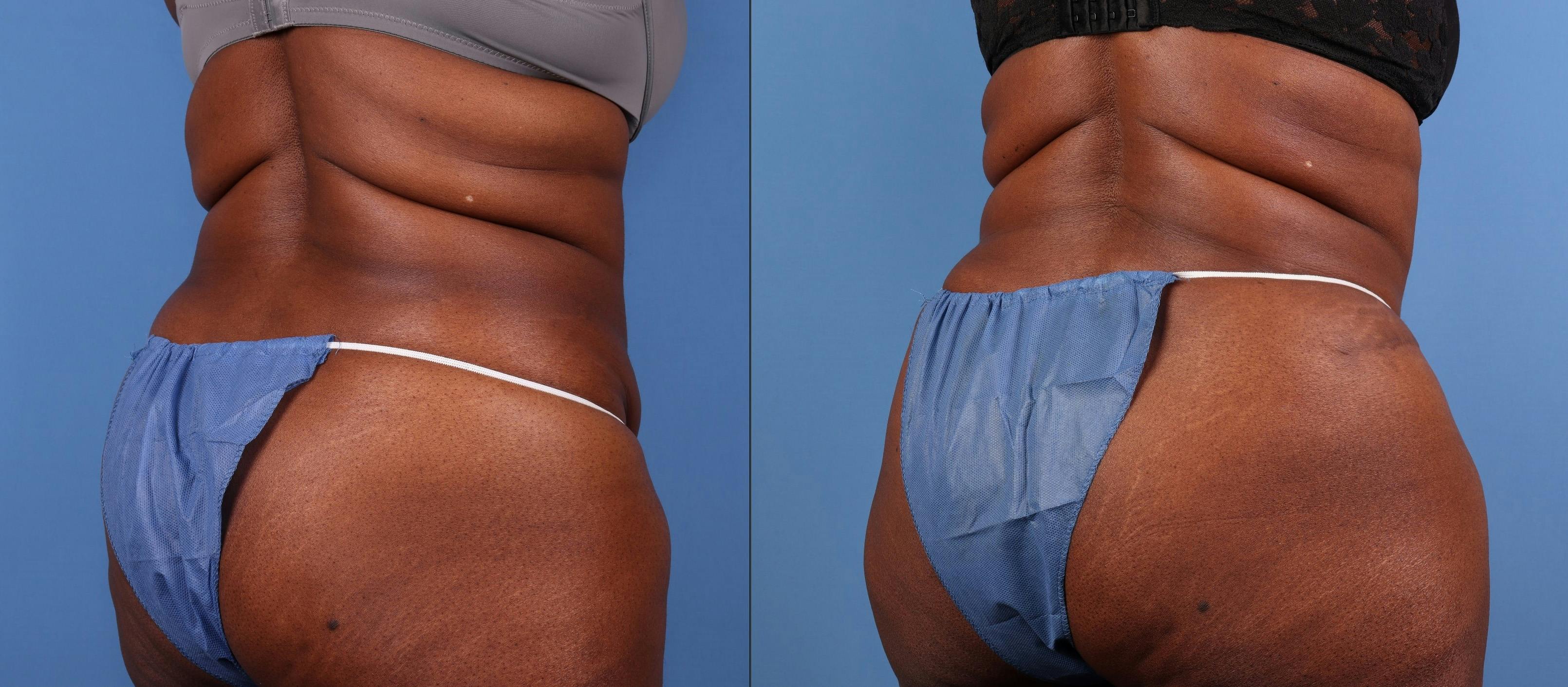 Abdomen Before & After Gallery - Patient 271002 - Image 4