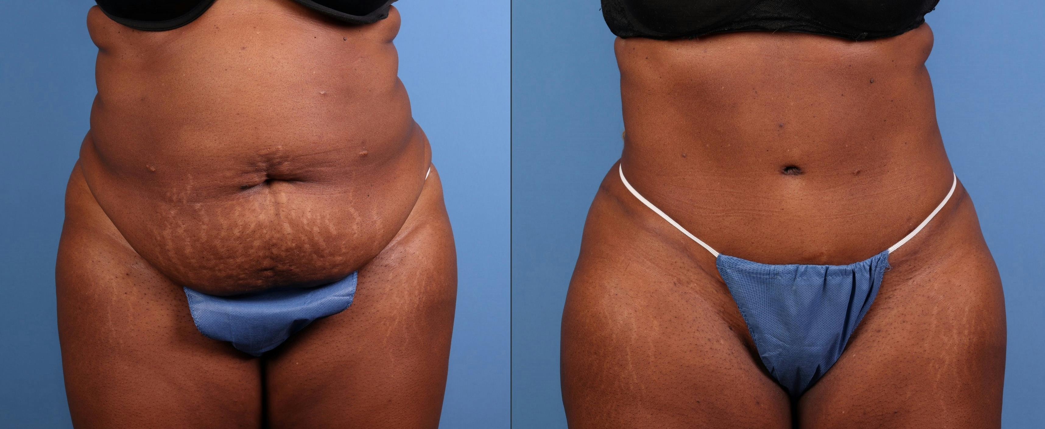 Abdomen Before & After Gallery - Patient 271002 - Image 1
