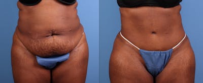 Tummy Tuck Before & After Gallery - Patient 873462 - Image 1