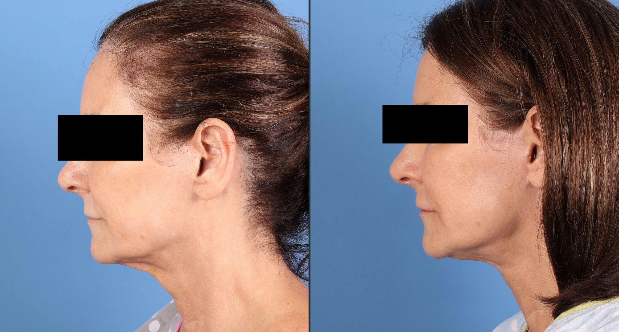 Neck Lift Before & After Gallery - Patient 123165 - Image 1