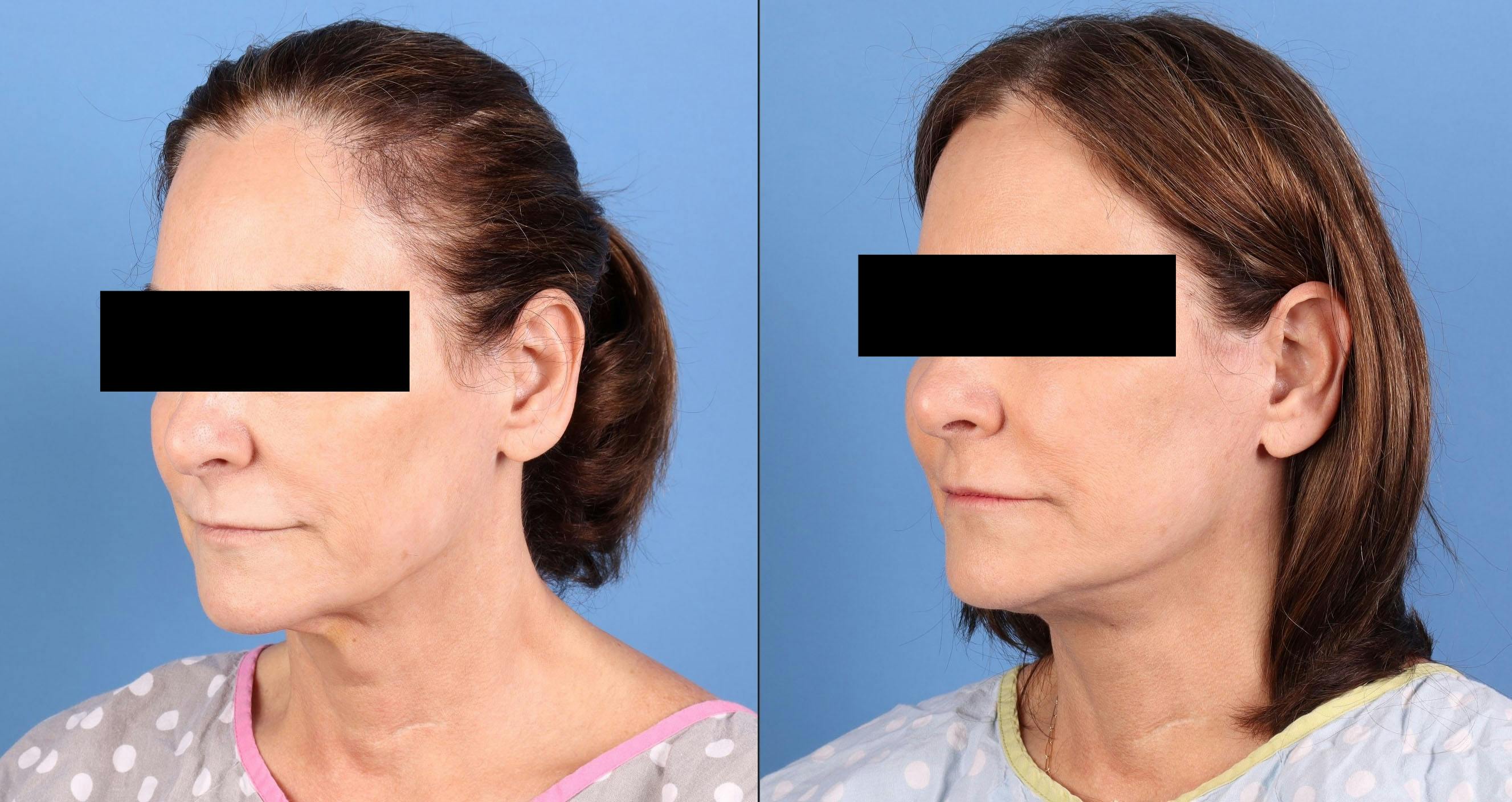 Neck Lift Before & After Gallery - Patient 123165 - Image 2