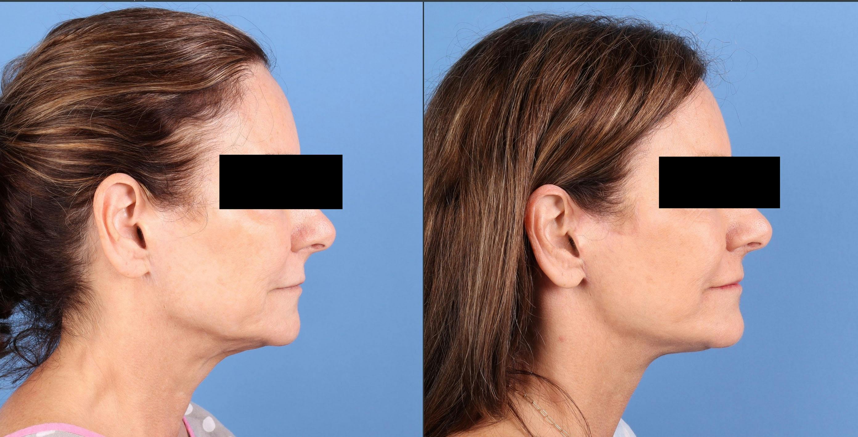 Neck Lift Before & After Gallery - Patient 123165 - Image 3