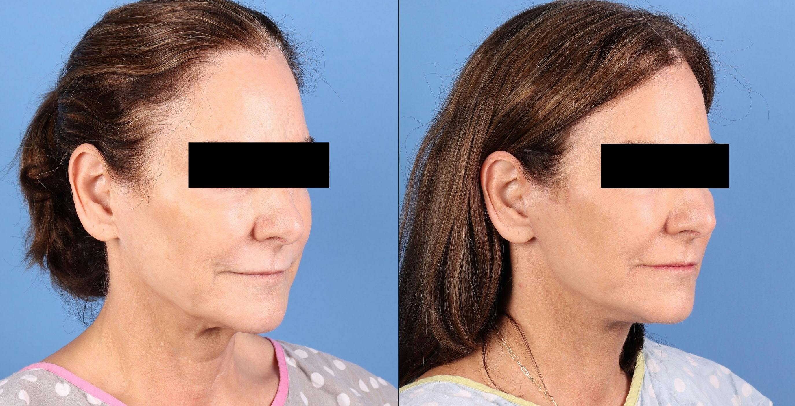 Neck Lift Before & After Gallery - Patient 123165 - Image 4