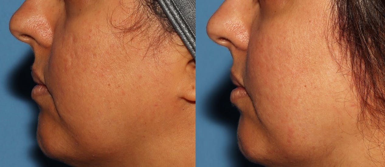 Acne Scar Treatment Before & After Gallery - Patient 178919 - Image 1