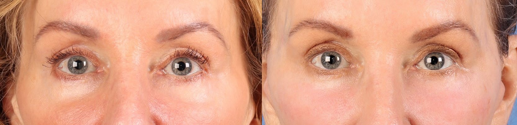 Facial Fillers Before & After Gallery - Patient 136604 - Image 3