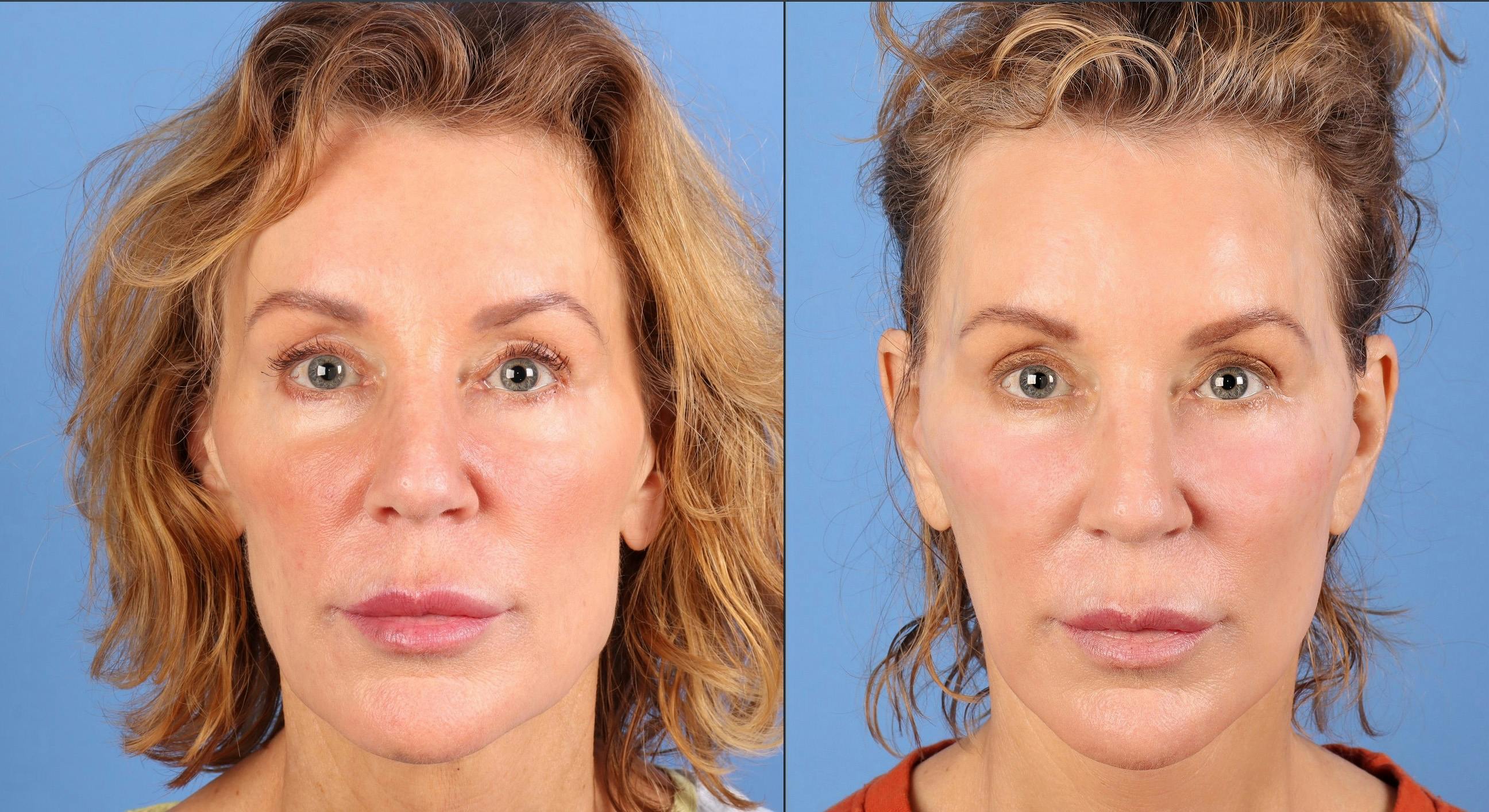 Facial Fillers Before & After Gallery - Patient 136604 - Image 1