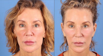 Facial Fillers Before & After Gallery - Patient 136604 - Image 1