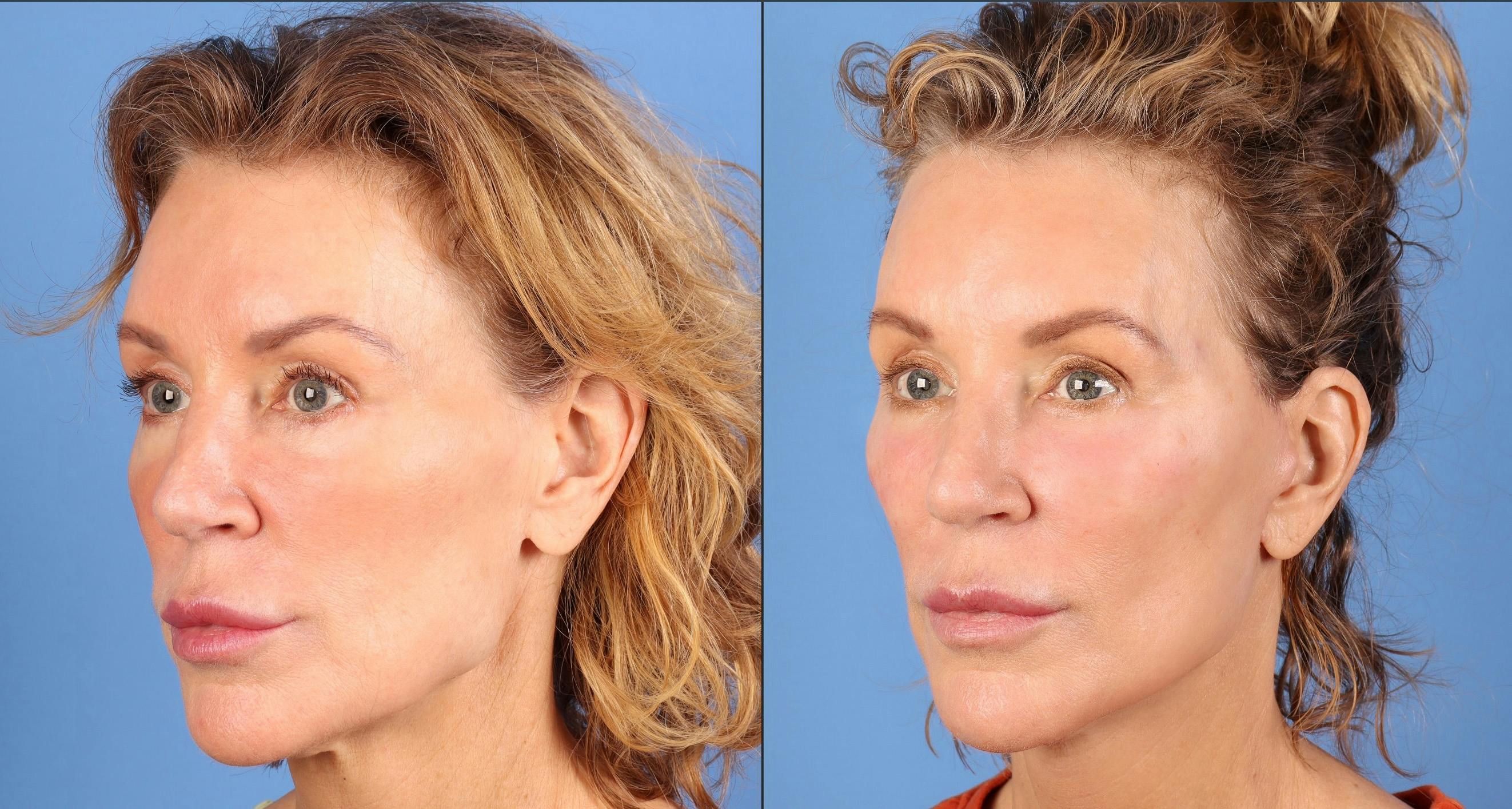 Facial Fillers Before & After Gallery - Patient 136604 - Image 4