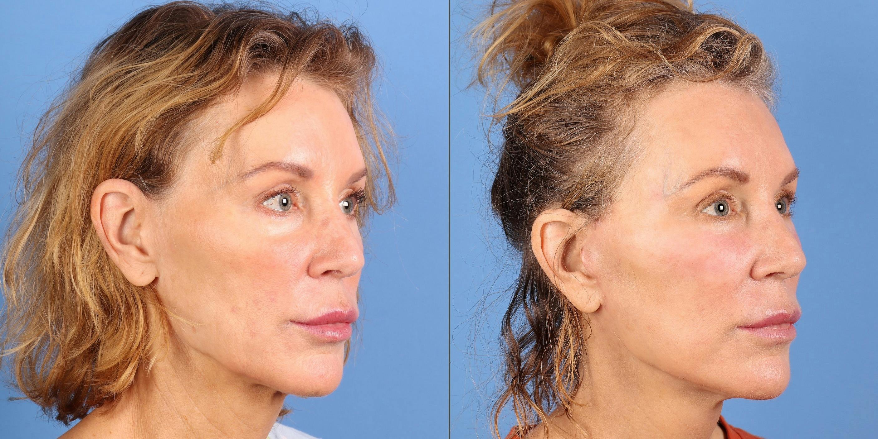 Facial Fillers Before & After Gallery - Patient 136604 - Image 2