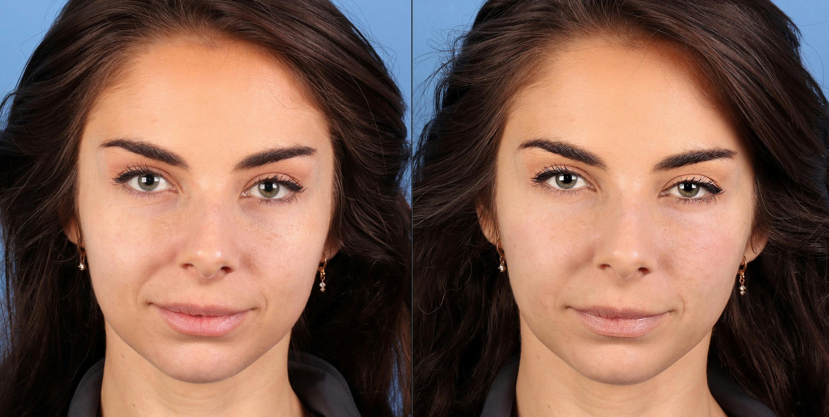 Facial Fillers Before & After Gallery - Patient 150693 - Image 1