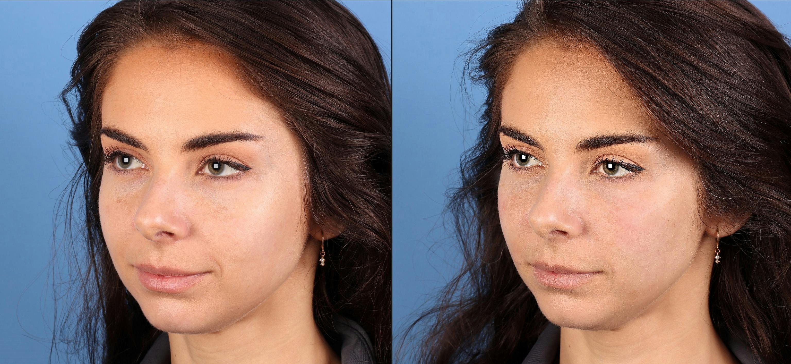 Facial Fillers Before & After Gallery - Patient 150693 - Image 2