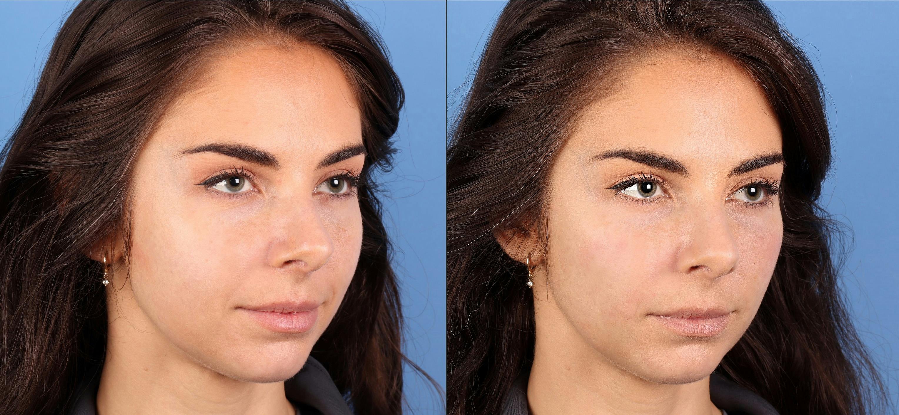 Facial Fillers Before & After Gallery - Patient 150693 - Image 3