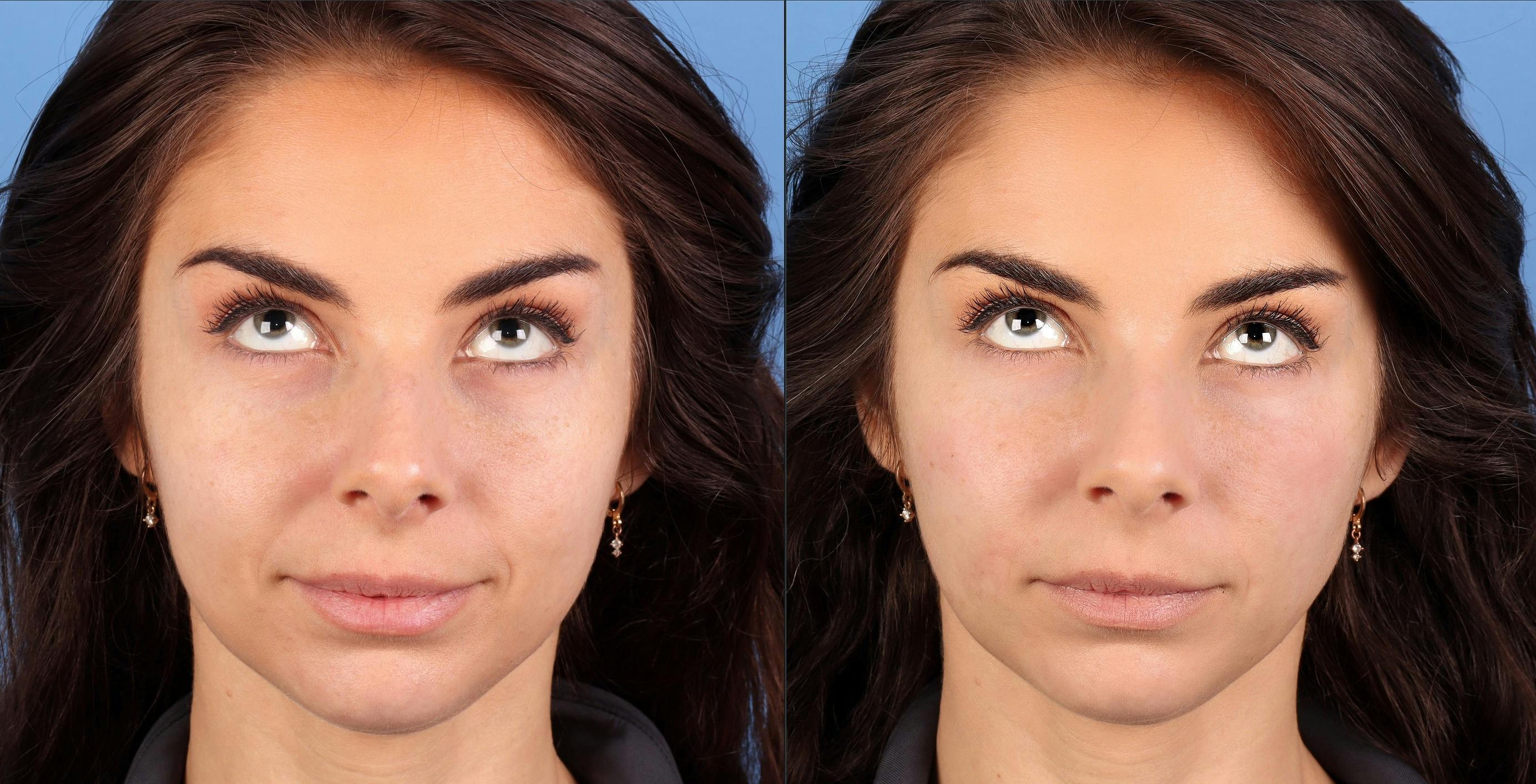Facial Fillers Before & After Gallery - Patient 150693 - Image 4