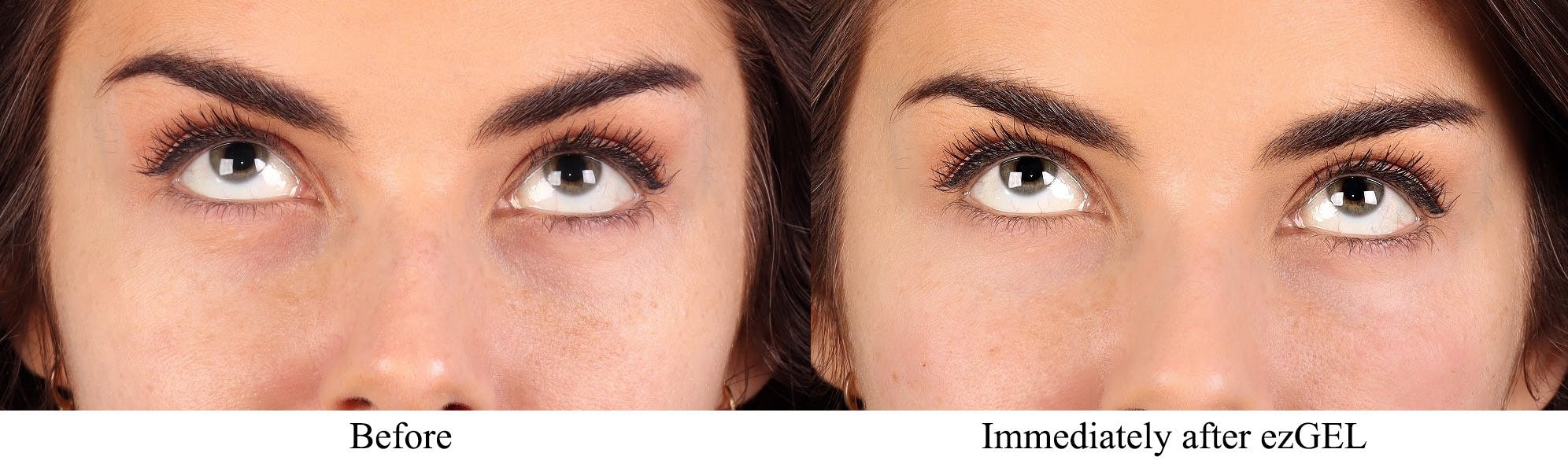 Facial Fillers Before & After Gallery - Patient 150693 - Image 5