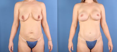 Tummy Tuck Before & After Gallery - Patient 392596 - Image 1