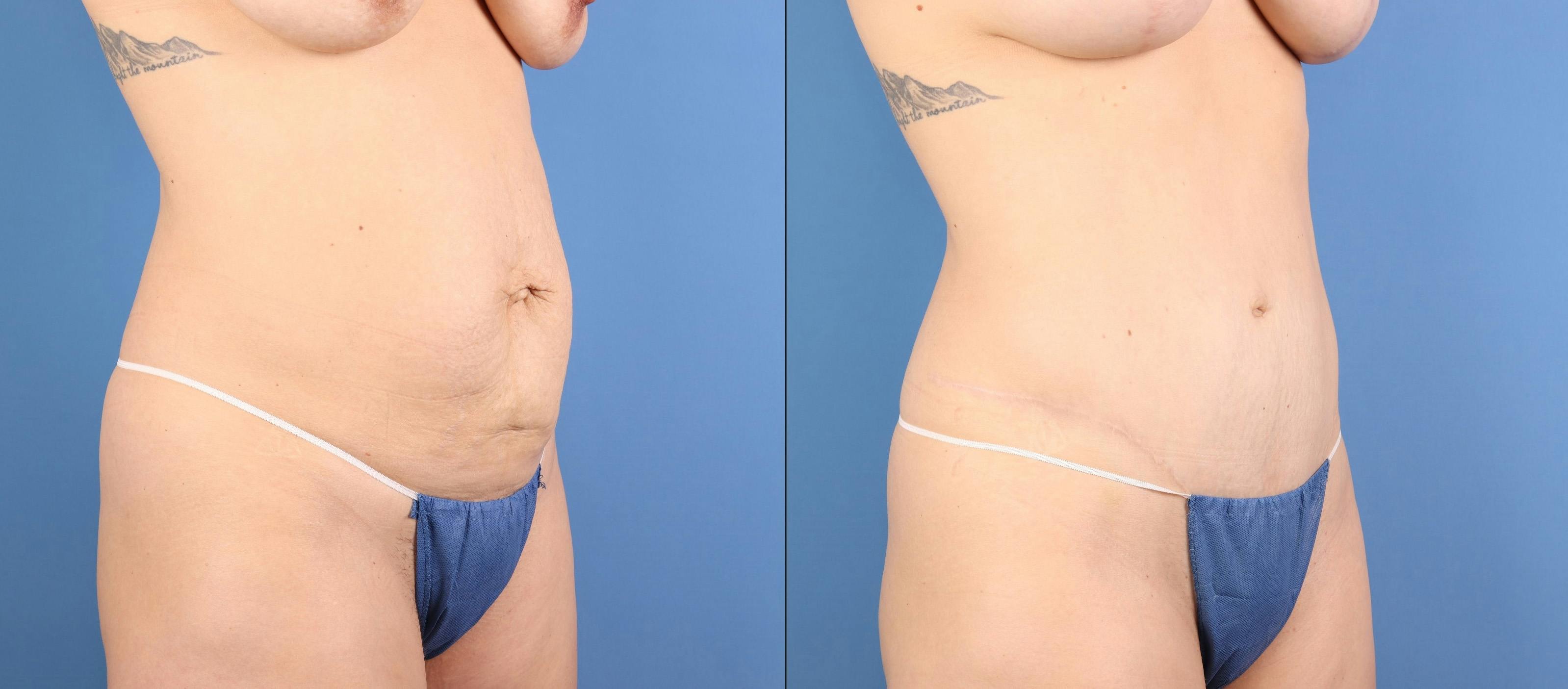 Tummy Tuck Before & After Gallery - Patient 392596 - Image 3