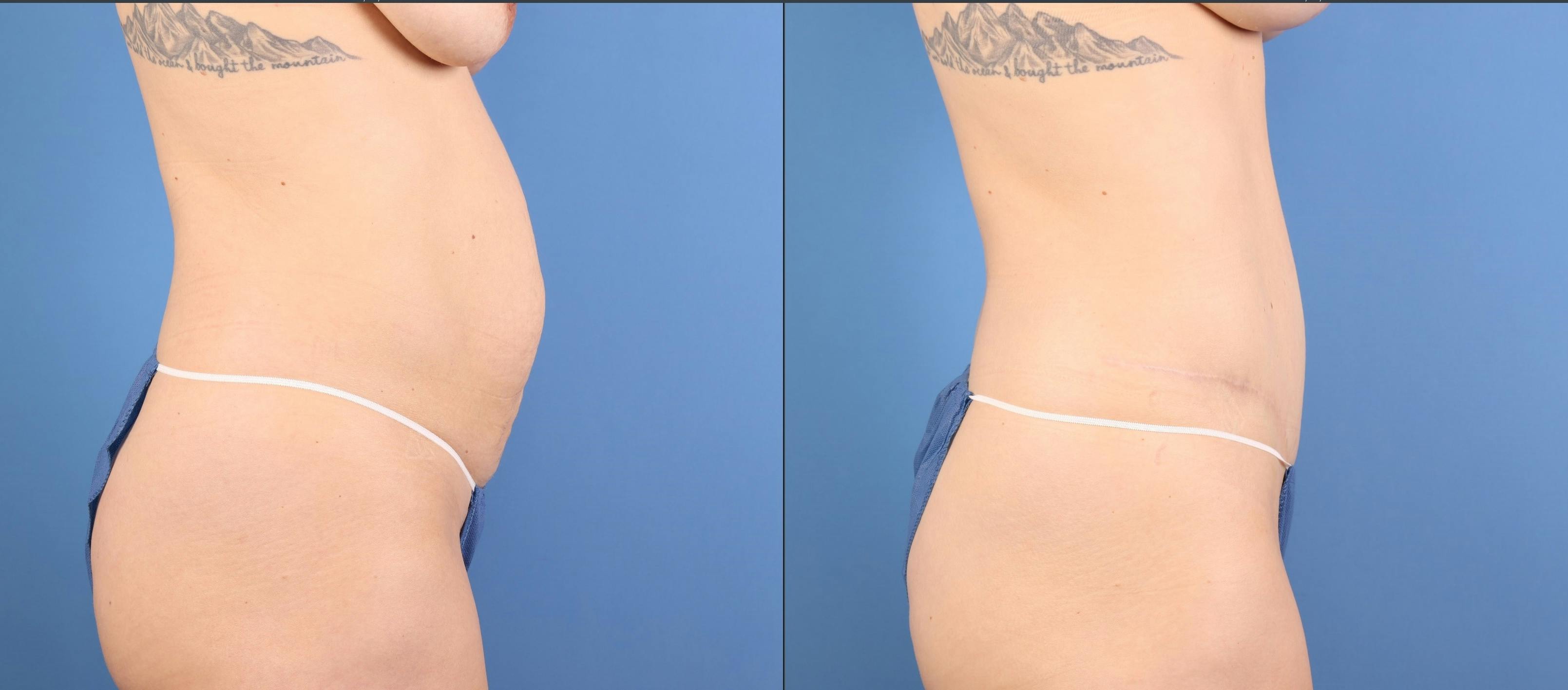 Tummy Tuck Before & After Gallery - Patient 392596 - Image 4