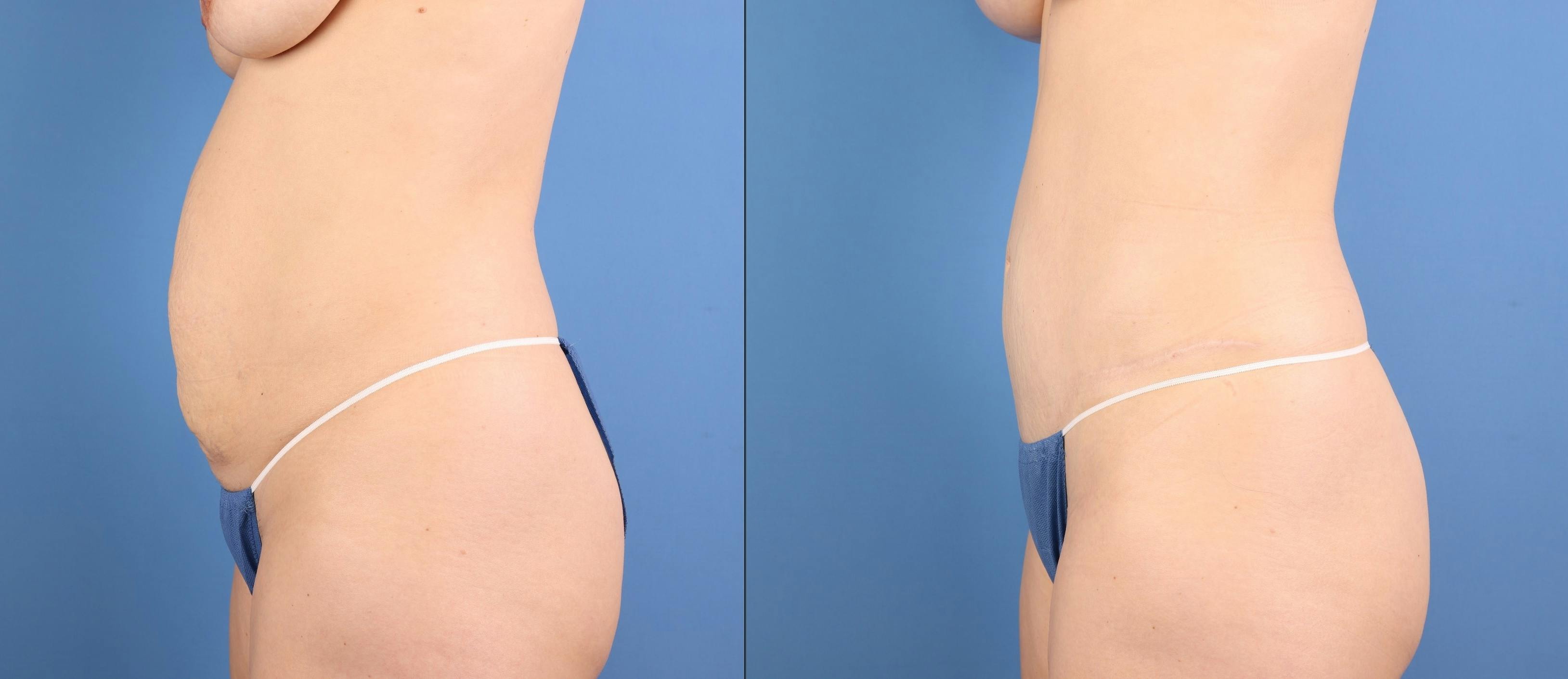Tummy Tuck Before & After Gallery - Patient 392596 - Image 6