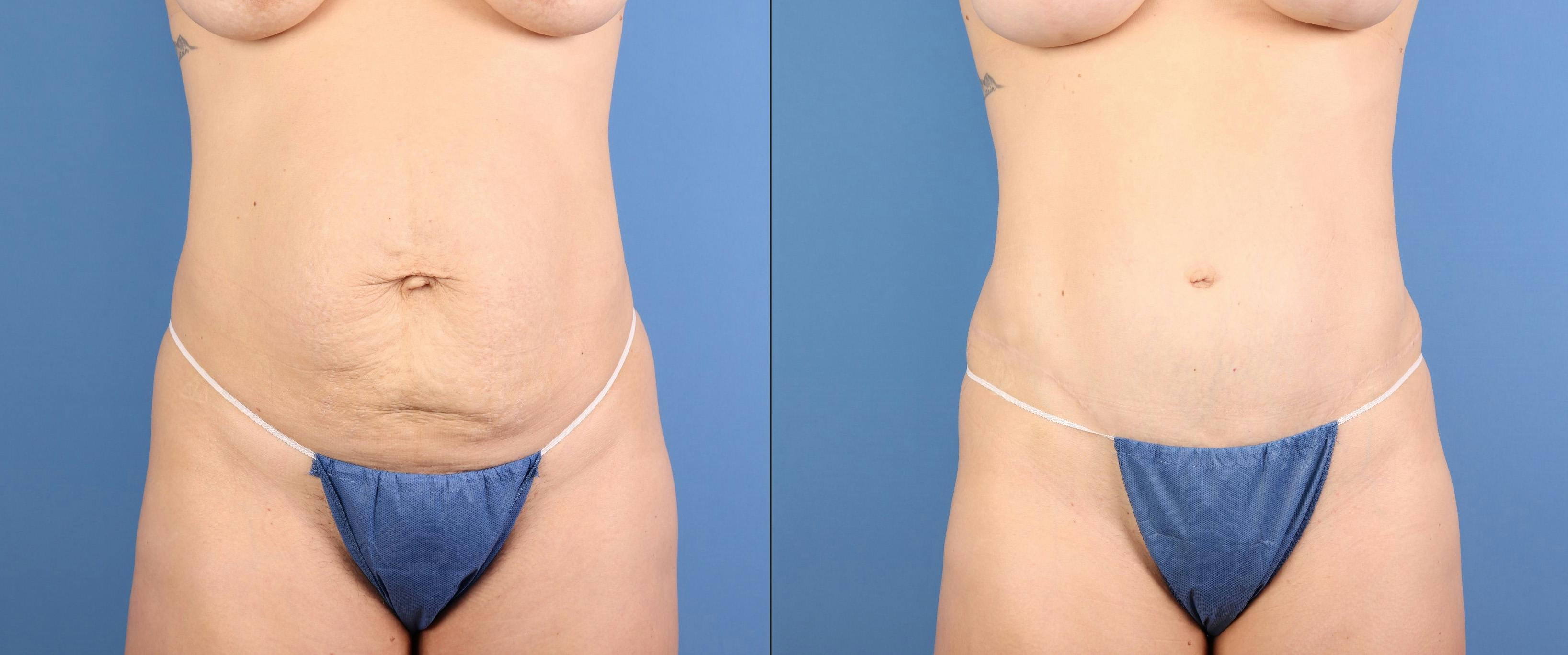 Tummy Tuck Before & After Gallery - Patient 392596 - Image 2