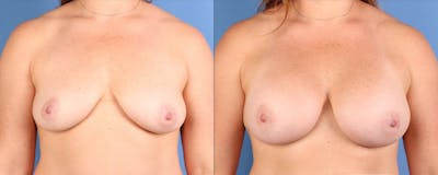 Breast Augmentation Before & After Gallery - Patient 716790 - Image 1