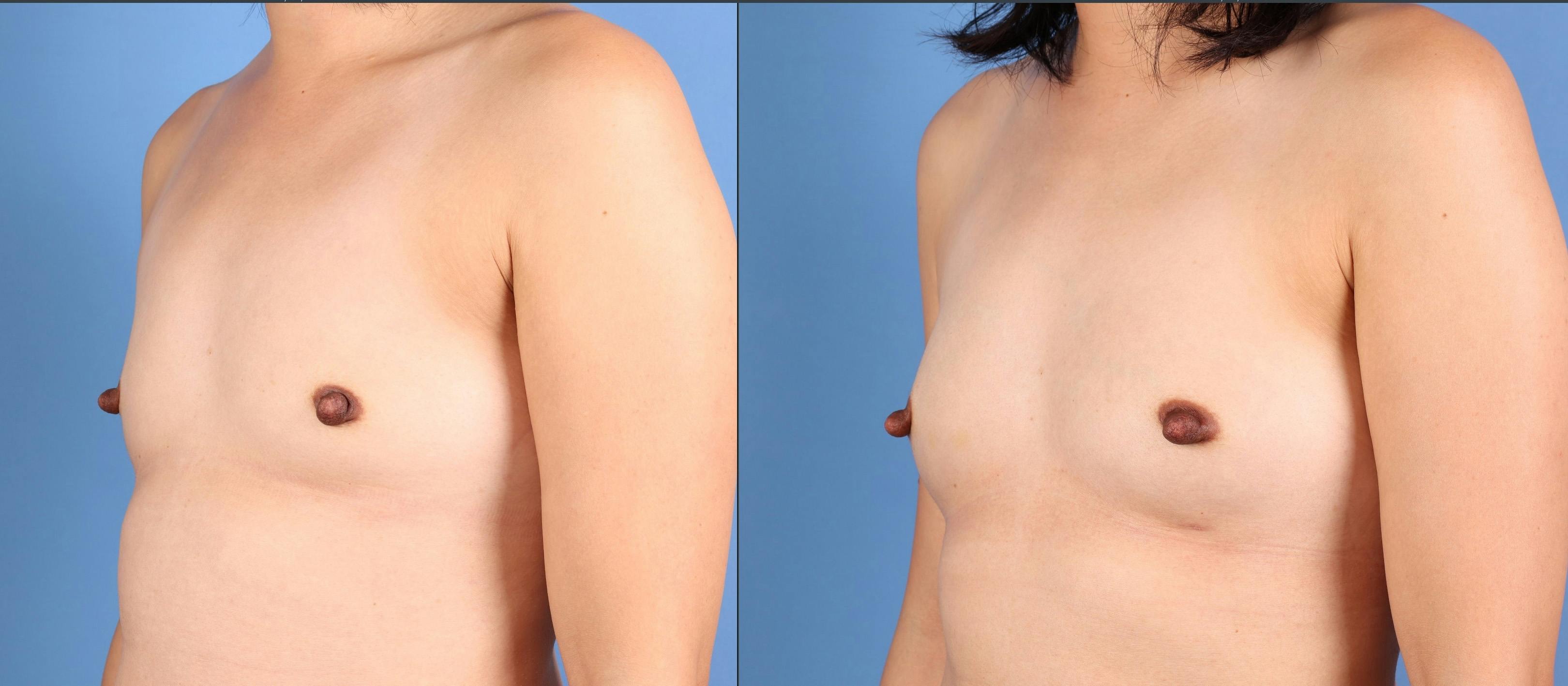 Fat Transfer Breast Augmentation Before & After Gallery - Patient 266649 - Image 4