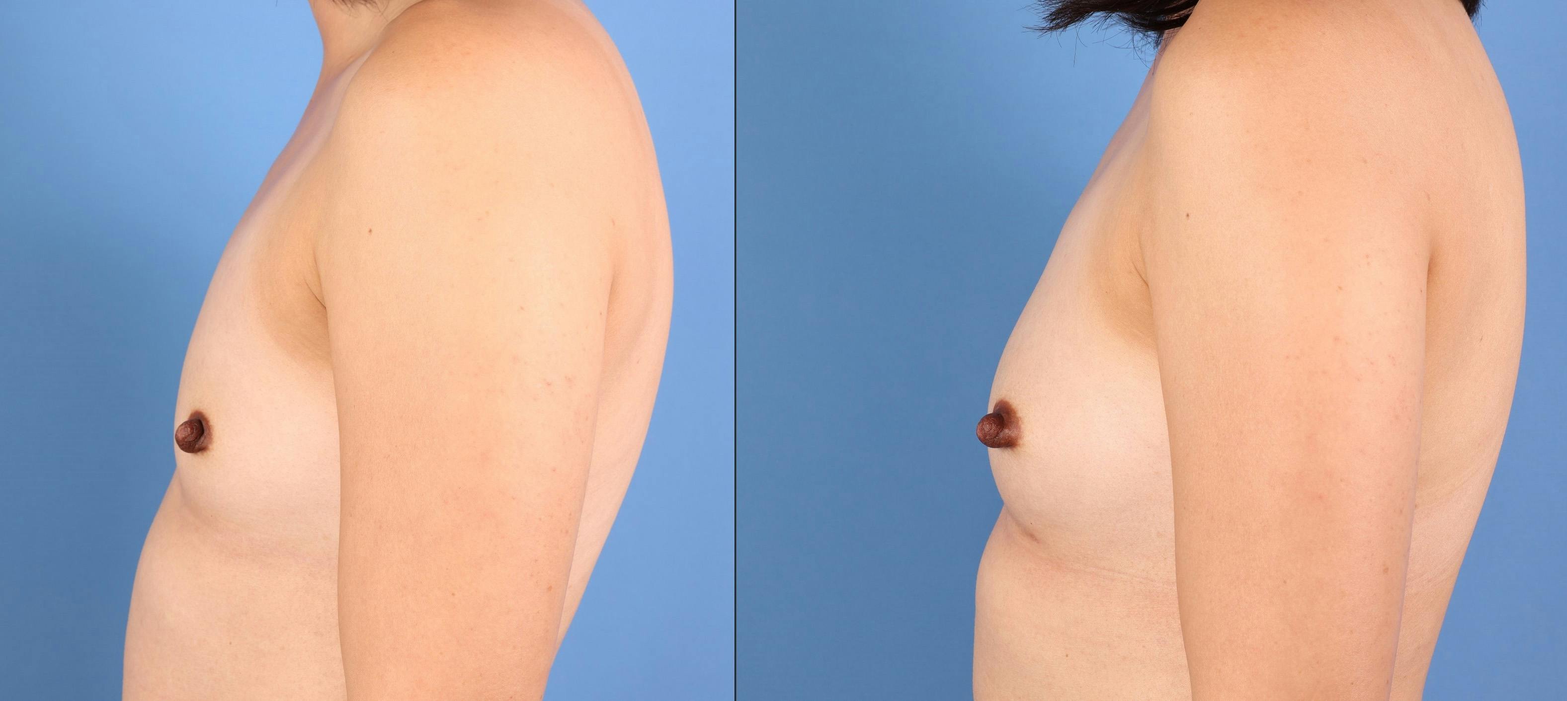 Fat Transfer Breast Augmentation Before & After Gallery - Patient 266649 - Image 5
