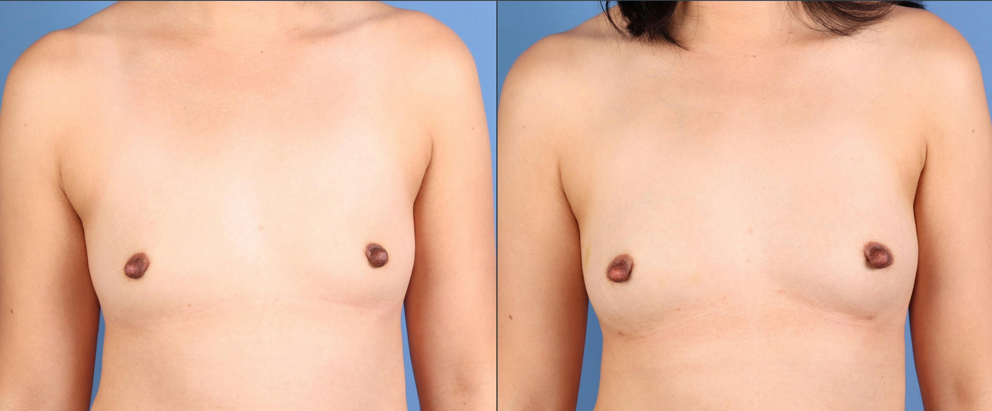 Fat Transfer Breast Augmentation Before & After Gallery - Patient 266649 - Image 1