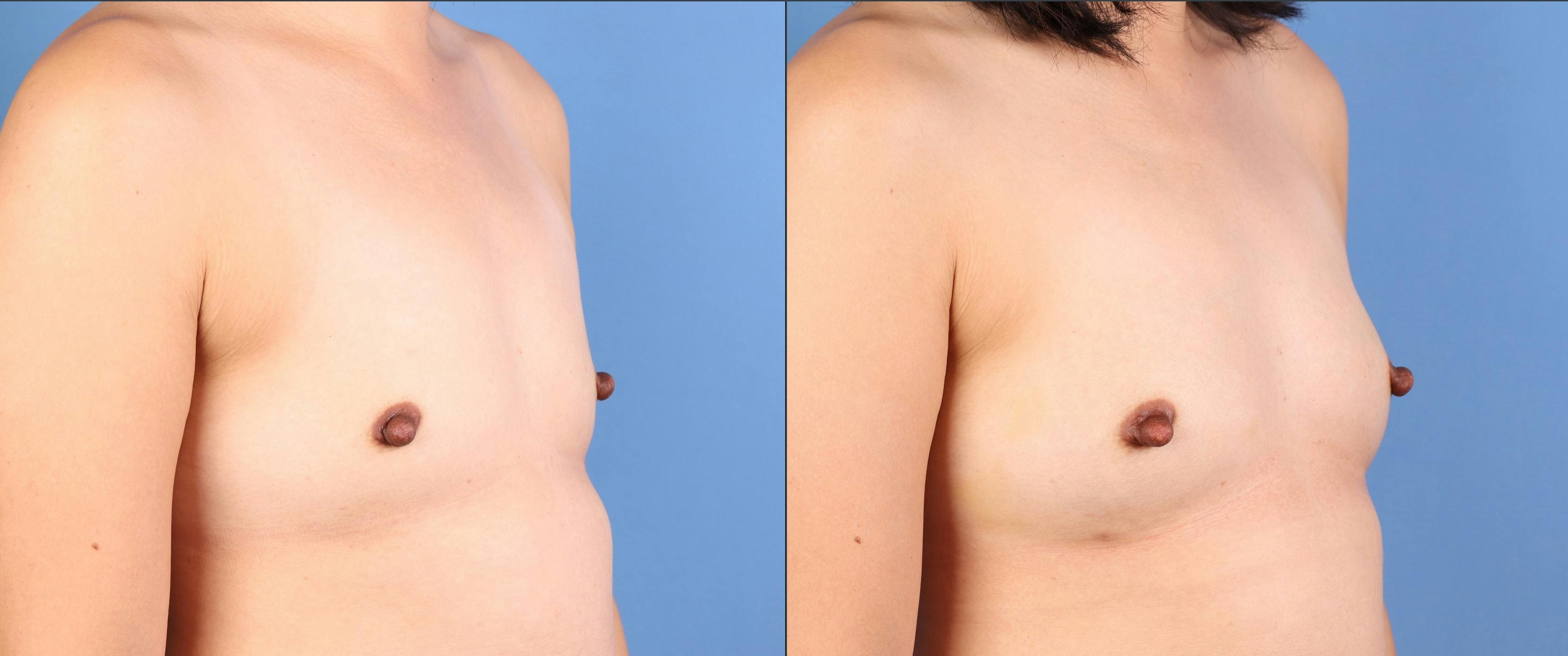 Fat Transfer Breast Augmentation Before & After Gallery - Patient 266649 - Image 2