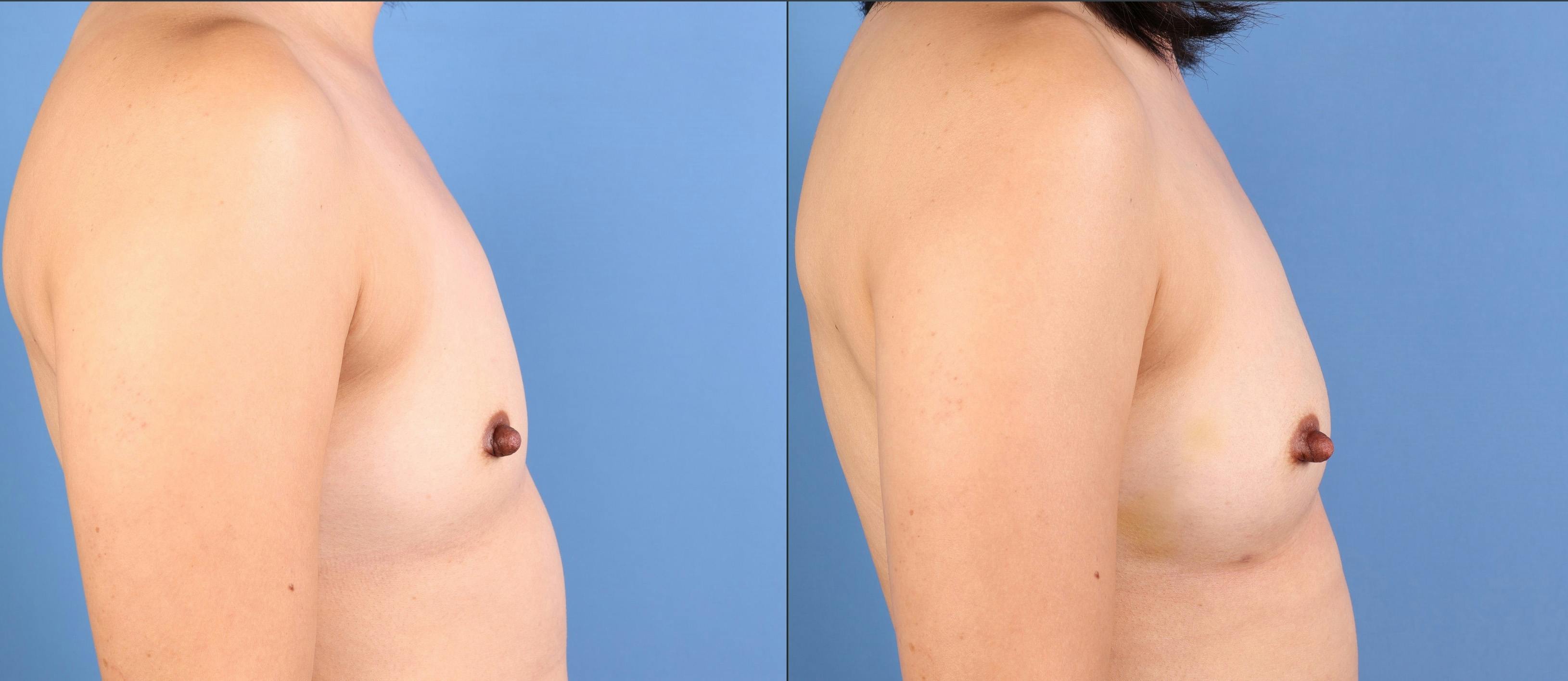 Fat Transfer Breast Augmentation Before & After Gallery - Patient 266649 - Image 3
