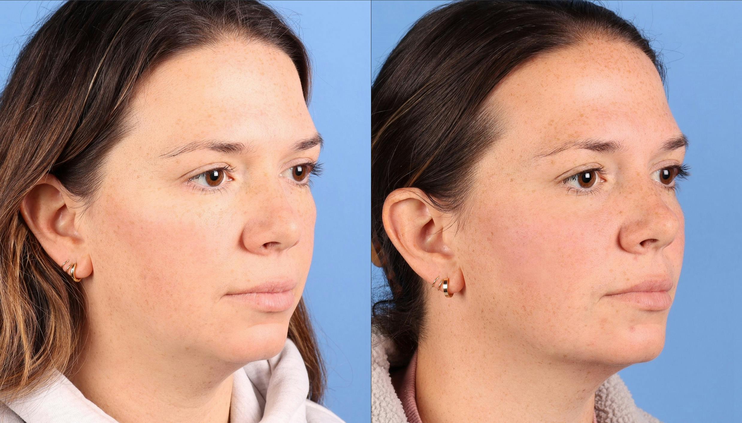 Facial Fillers Before & After Gallery - Patient 130110 - Image 2