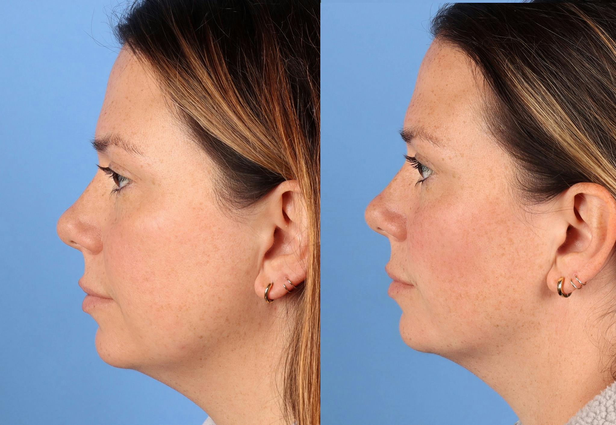 Facial Fillers Before & After Gallery - Patient 130110 - Image 4