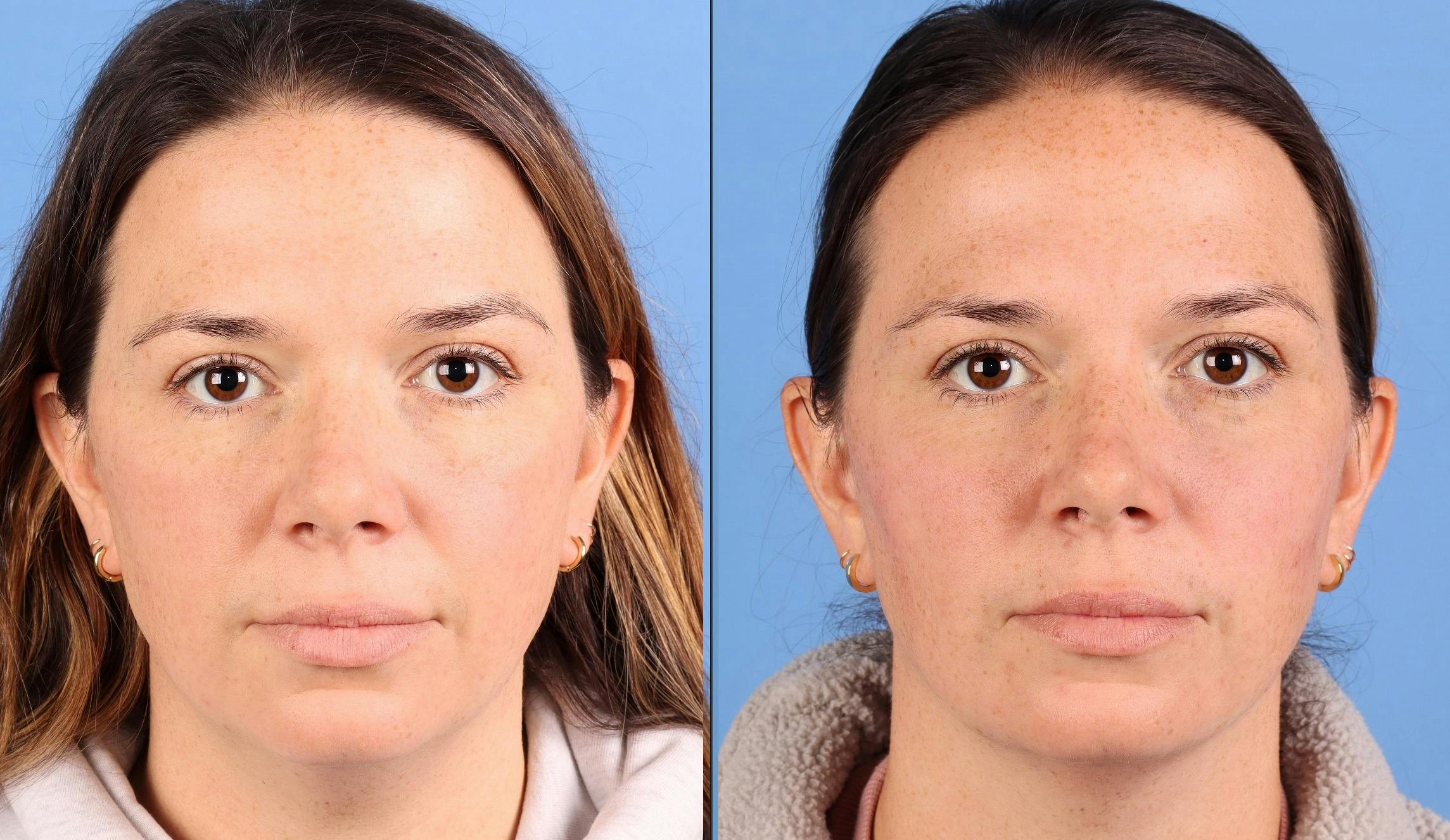 Facial Fillers Before & After Gallery - Patient 130110 - Image 1