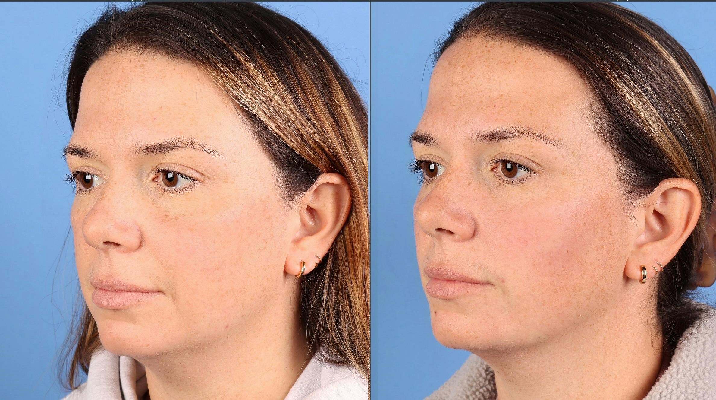 Facial Fillers Before & After Gallery - Patient 130110 - Image 3