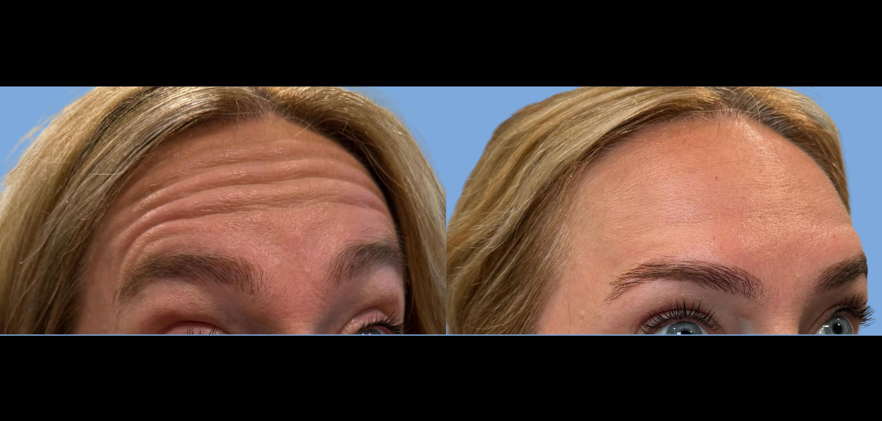 Botox Before & After Gallery - Patient 943317 - Image 1