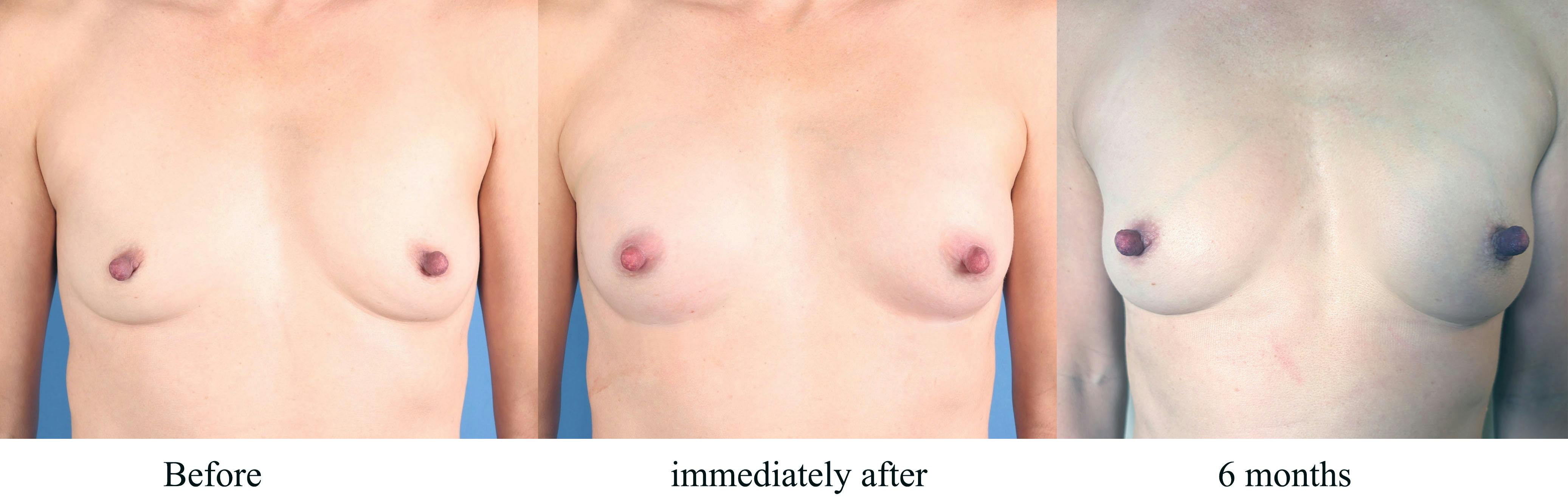 AlloClae Before & After Gallery - Patient 275863 - Image 1