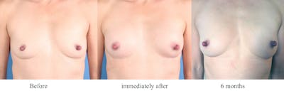 AlloClae Before & After Gallery - Patient 275863 - Image 1