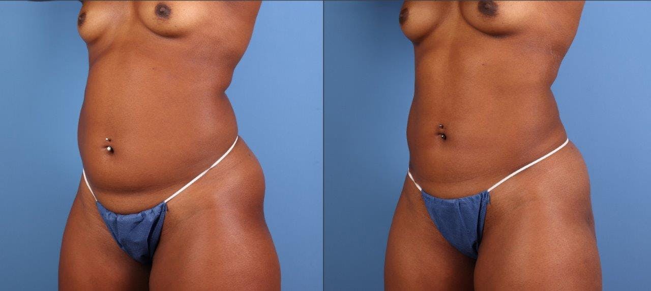Abdomen Before & After Gallery - Patient 281383 - Image 3