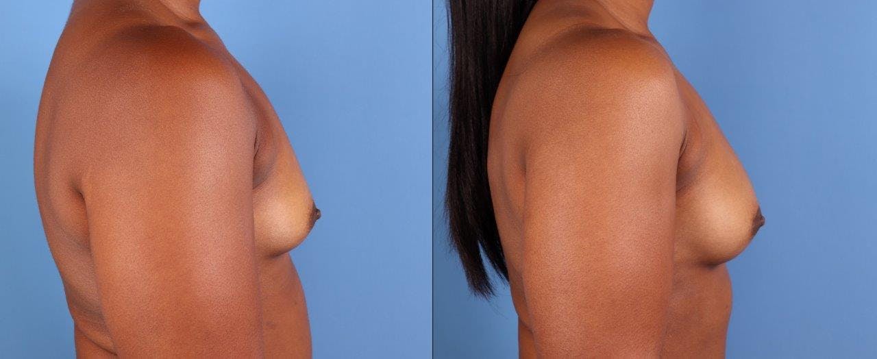 Abdomen Before & After Gallery - Patient 281383 - Image 11