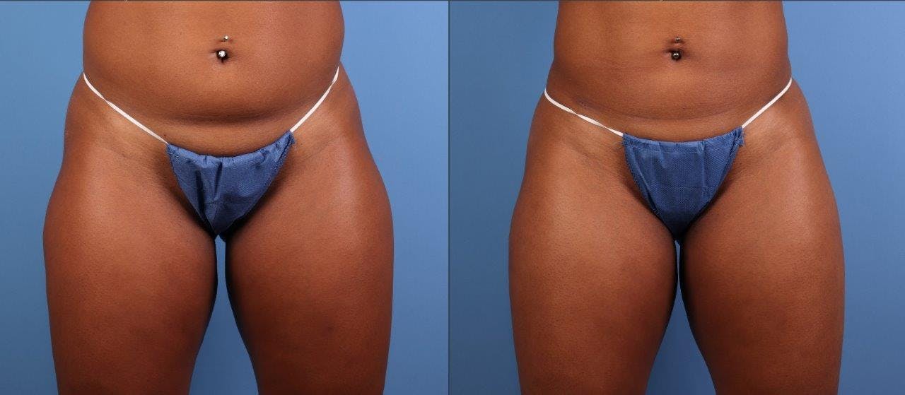 Abdomen Before & After Gallery - Patient 281383 - Image 4
